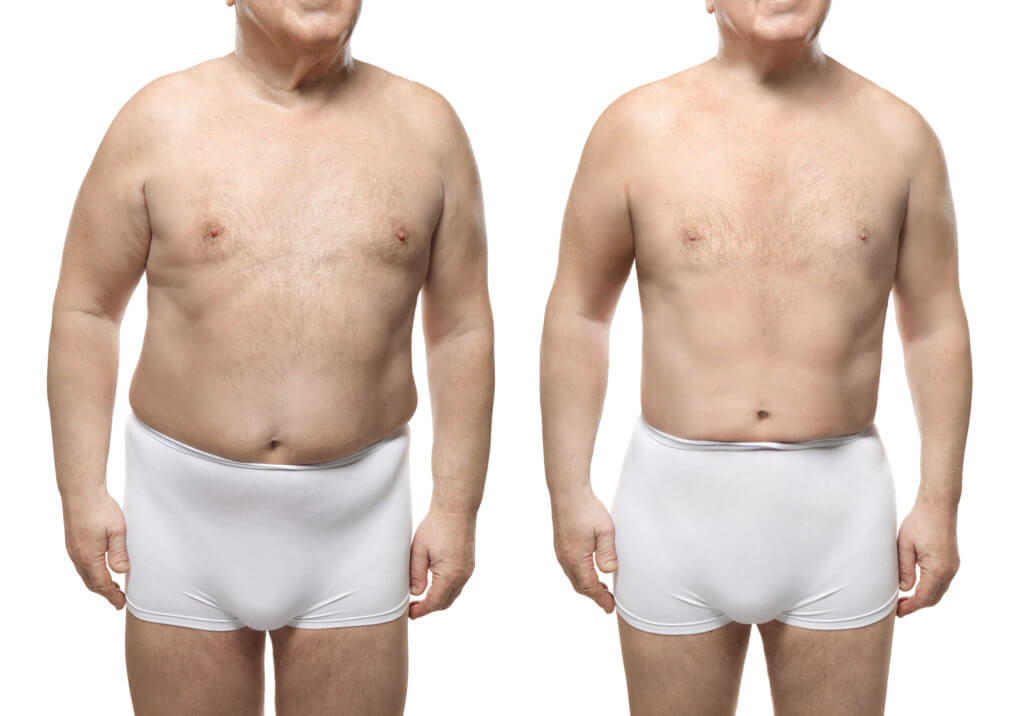 Liposuction for Men