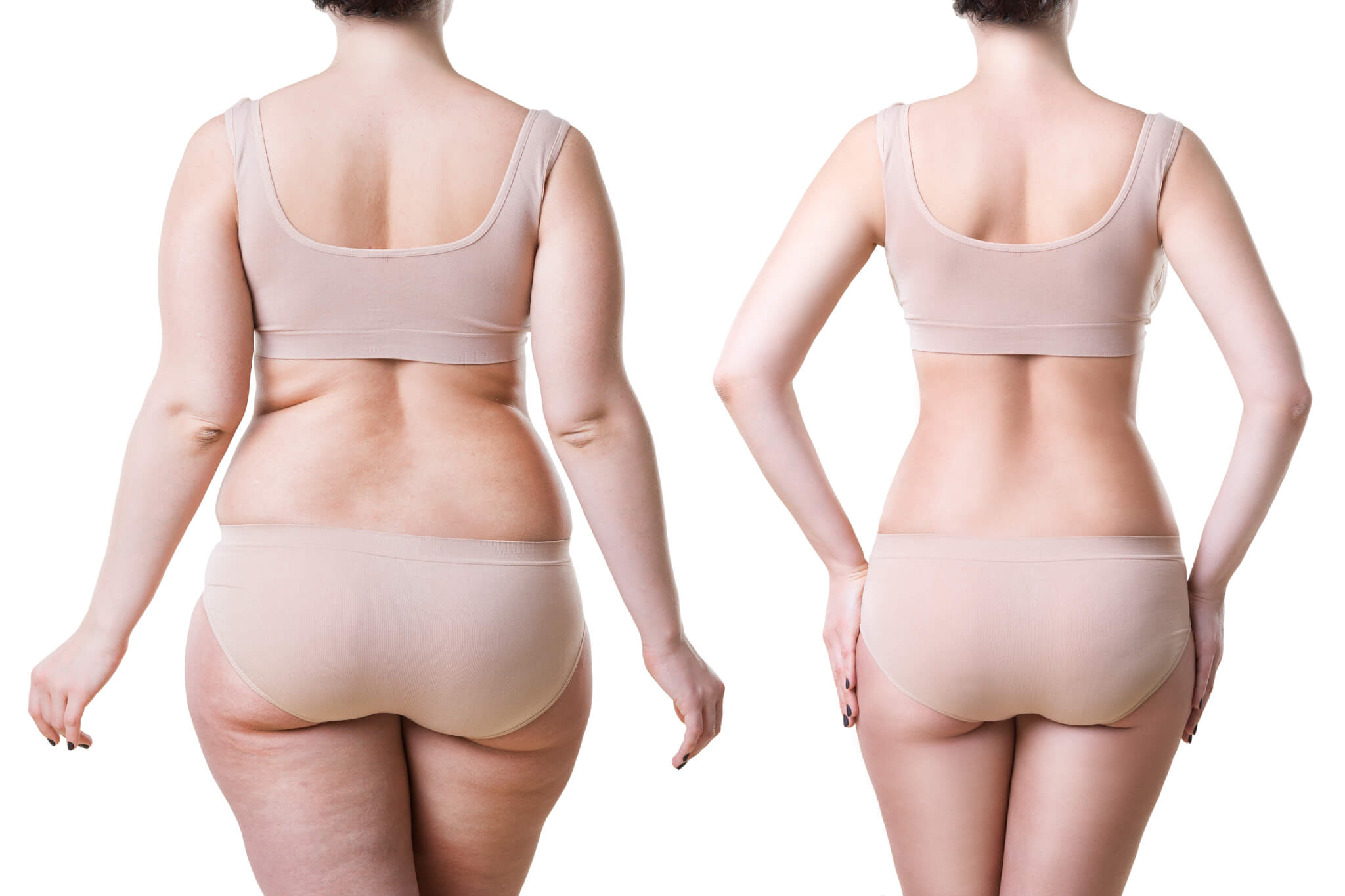 Losing Weight with Liposuction