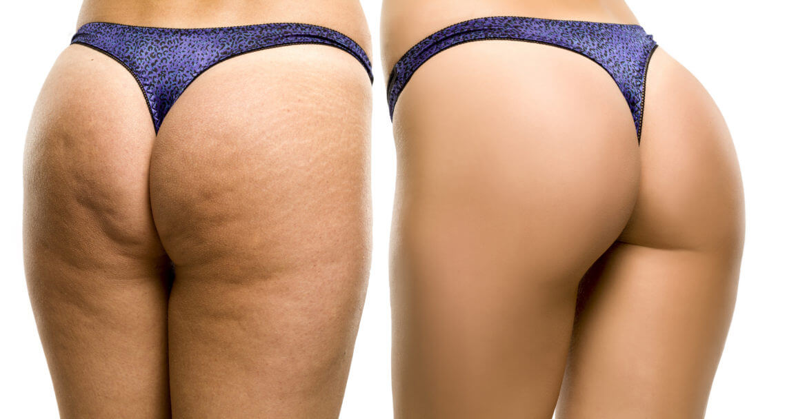 Should I Use Liposuction to Treat Cellulite