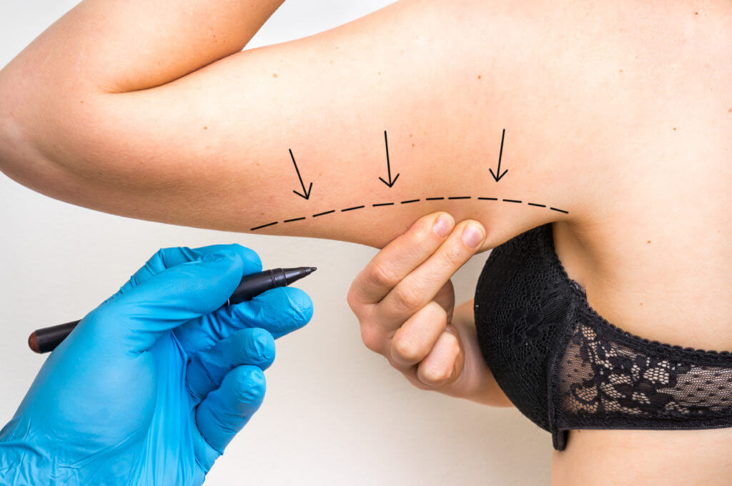 What to Know About Upper Arm Liposuction