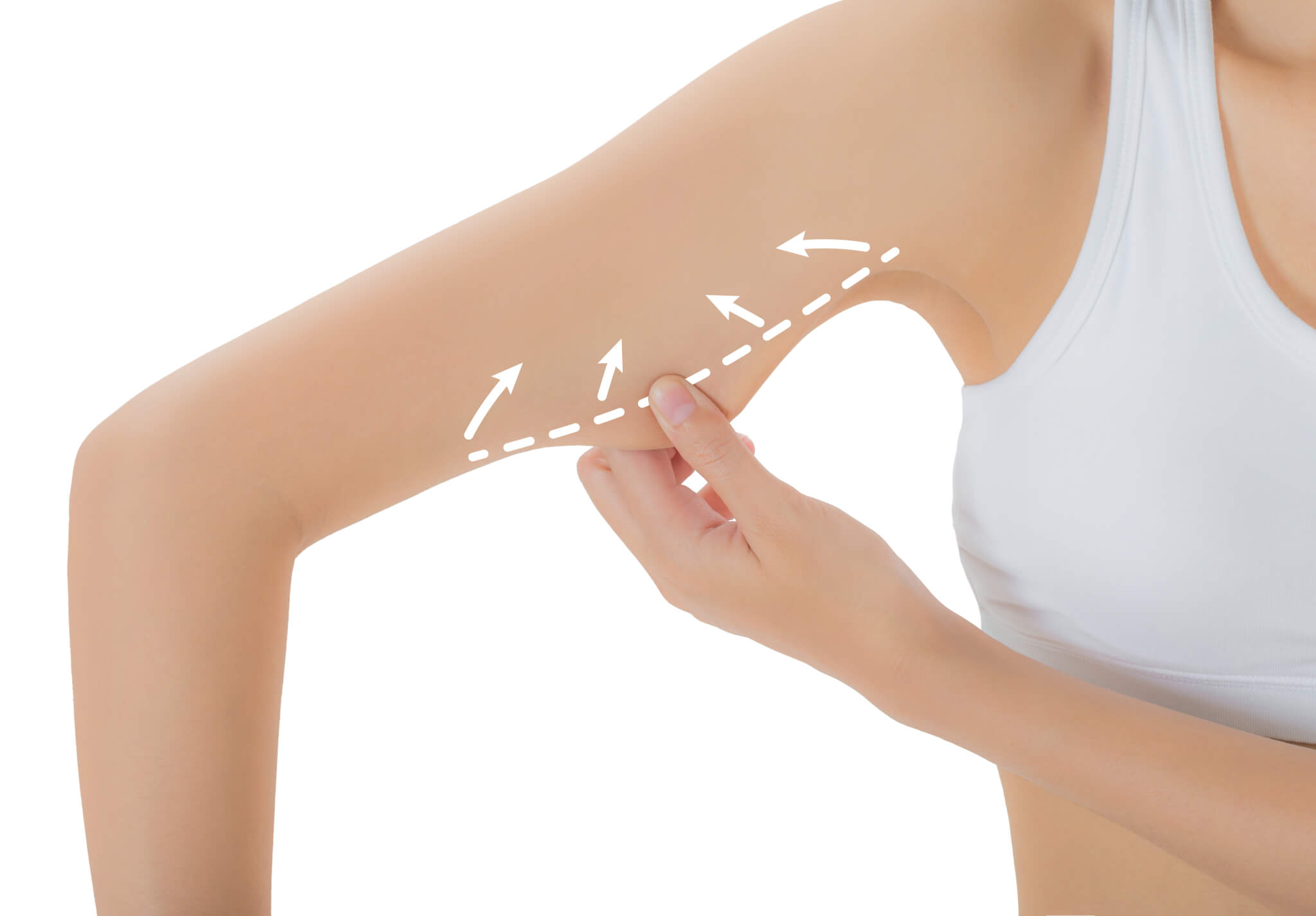 What to Know About Upper Arm Liposuction