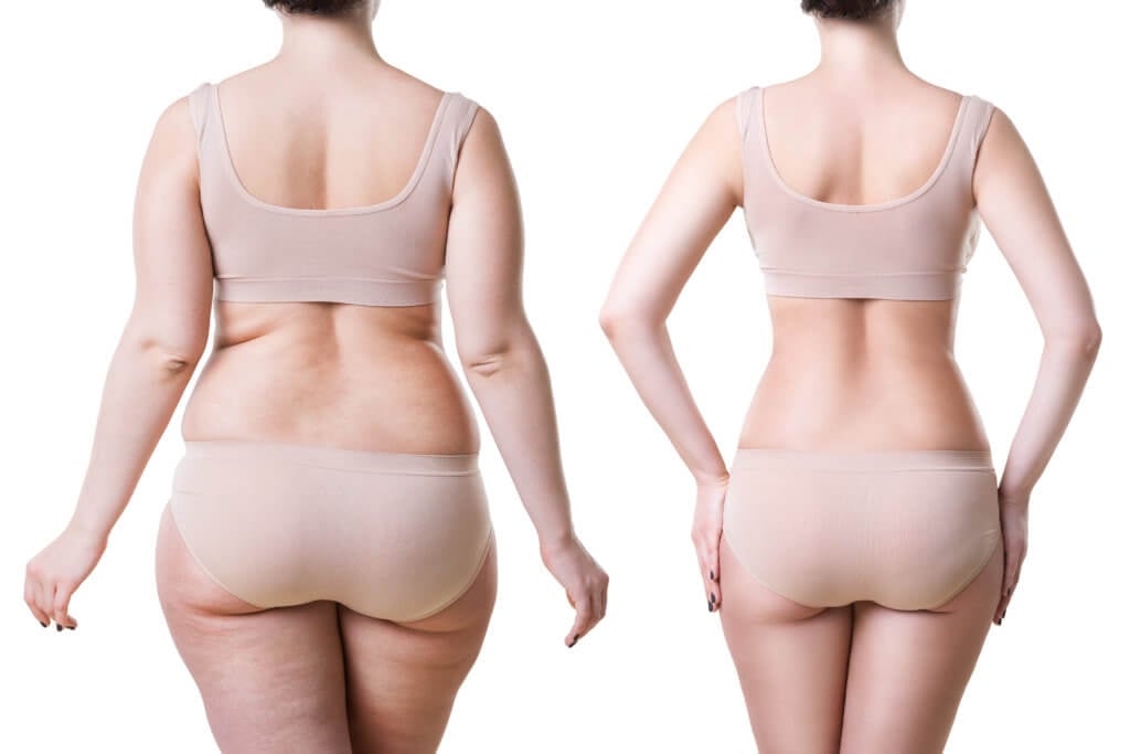 Is Liposuction Really Worth It