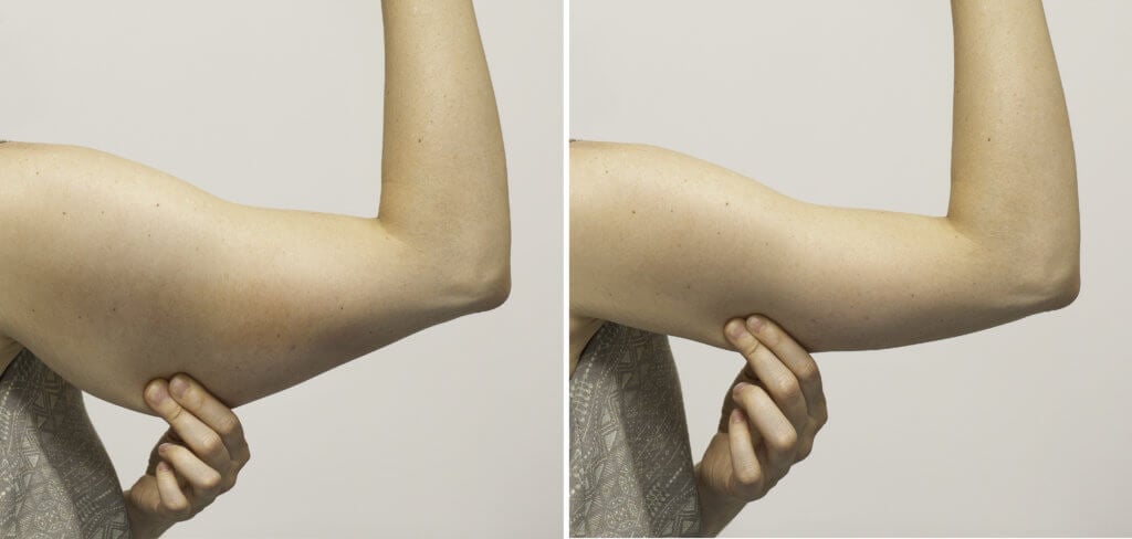Liposuction vs CoolSculpting for the Arms2